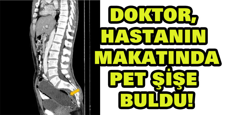 Doktorlar, 3 gündür tuvalete çıkamayan adamın makatında 12 santimetrelik pet şişe buldu!